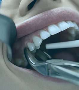 Fig. 210S Upper Second Molars
